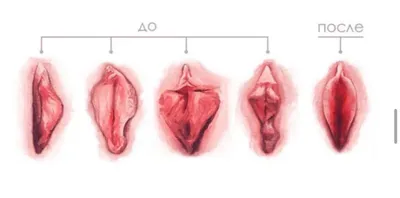Лабиопластика - цена операции по пластике больших и малых половых губ в  Москве | АльтраВита