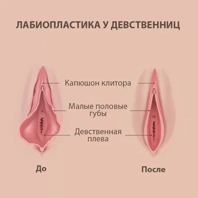 Пластика влагалища (вагинопластика) - цена, операция по пластике передней и  задней стенок влагалища в Москве