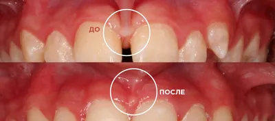 Пластика уздечки губы – методы, отзывы, цена