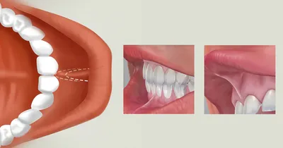 Пластика уздечки языка | Стоматология на Авиамоторной - СпектрДент | Дзен