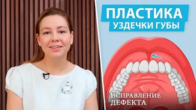 Пластика уздечки языка: цены на лазерную коррекцию в Москве - Стоматология  Елены Мокренко