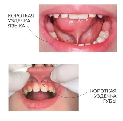 Пластика уздечки языка и губы - Клиника Сатори