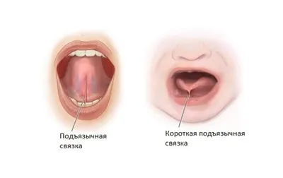 Пластика уздечки языка и губы лазером в Москве | Клиника \"МАЙ\"