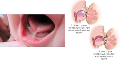 Логопед после подрезания уздечки у ребенка. Блог Лого-Эксперт