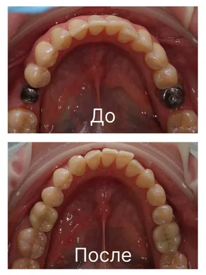 Пластика уздечки верхней губы диодным лазером Doctor Smile :: NORD DENTAL —  семейная стоматология. Две клиники на севере Петербурга