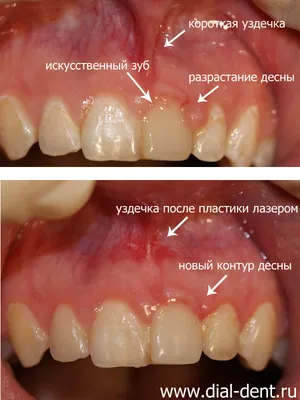 Коррекция уздечек и тяжей лазером | Детская и семейная стоматологическая  клиника \"Белая Медведица\" | Санкт-Петербург