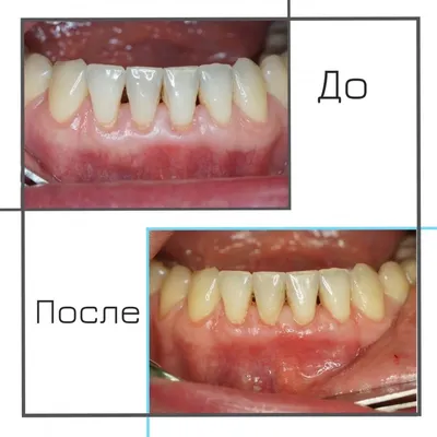 Пластика рецессии десны, фото до и после, пример работы 47676