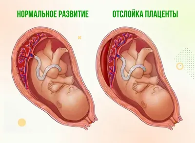 Женщины начали есть свою же плаценту: бред или польза? | ДЕЛьныйМЕДхакер |  Дзен