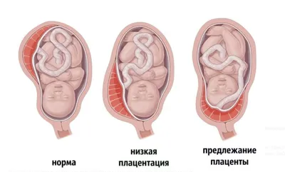 Плацента, пузырьковый корд и плод, прикрепленная модель вискозы, анатомия  внутренних органов новорожденных, модель плаценты для новорожденных |  AliExpress