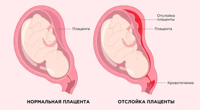 Преждевременная отслойка плаценты: можно ли ее остановить?