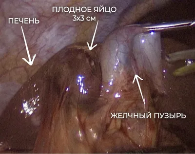 Clinic gooddoctor - В норме плодное яйцо обнаруживается в полости матки на  УЗИ с 5й недели беременности (срок акушерский ☝🏻, отсчитываем от первого  дня последней менструации! Это примерно неделя задержки или 3