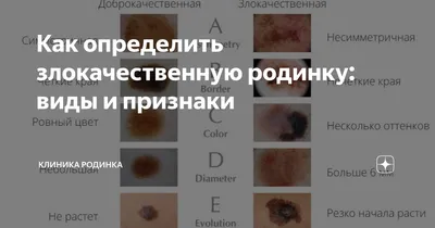 Хорошие» и «плохие» родинки: врач-онколог о том, что нужно знать об их  удалении — Интернет-канал «TV Губерния»