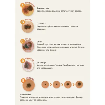 Что такое меланома? / Здравствуйте - YouTube