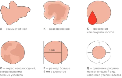 Как узнать, что ваша родинка может превратиться в рак? - Рамблер/новости