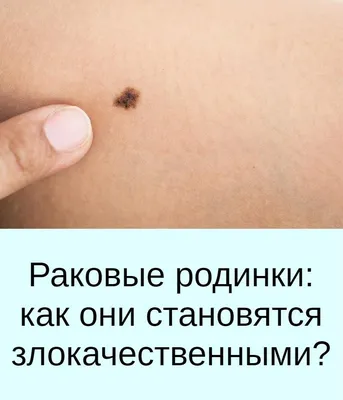 ТОЛЬКО РОДИНКУ МОЮ НЕ ТРОГАЙТЕ!😬 ⠀ Родинка (от латинского «невус») – это  пигментное образование, содержащее в своей основе меланин и… | Instagram