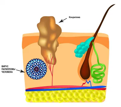 Что такое папиллома и чем она вызвана. Разновидности папиллом.