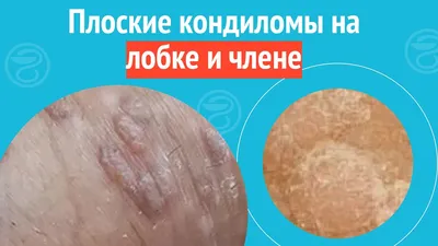 Удаление папиллом - Бушуев Семен Дмитриевич