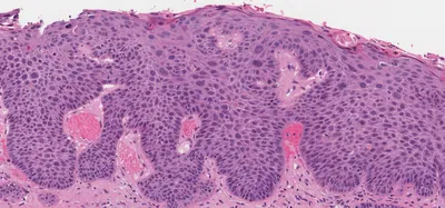 Плоскоклеточный рак in situ гортани | MyPathologyReport.ca