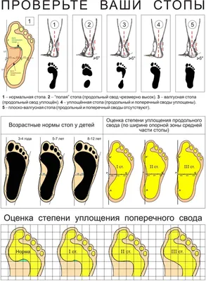 Виды плоскостопия - Детская обувь Twinboots