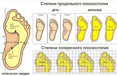 Почему люди с плоскостопием могут не служить в армии?