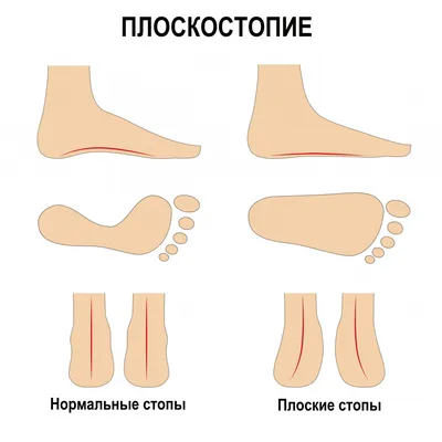 3-4 степень плоскостопия, операция. | Портал радиологов