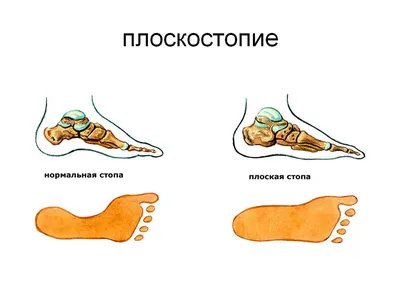 Как я сделал операцию от плоскостопия | Пикабу