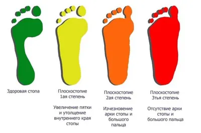 Виды и степени плоскостопия: лечение и профилактика