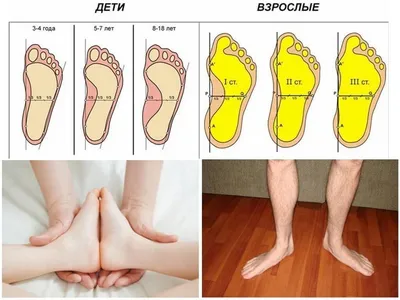 Плоскостопие: поперечное, продольное, ортопедические стельки