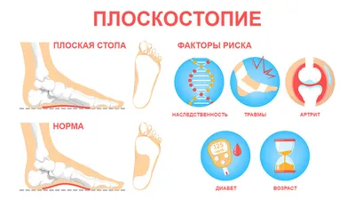 Как я сделал операцию от плоскостопия | Пикабу