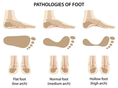 Степени и способы лечения плоскостопия — блог медицинского центра ОН Клиник