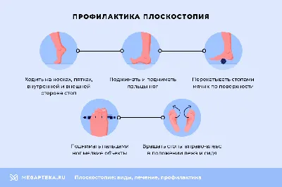 Поперечное плоскостопие или косточка на стопе - Ortoland