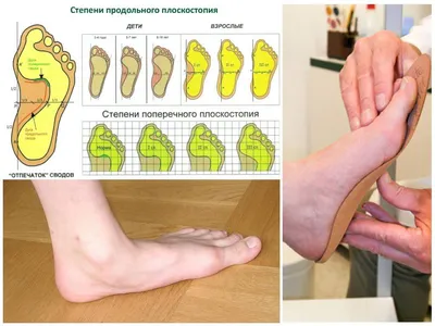 Комбинированное плоскостопие 1,2,3 степени - лечение комбинированного  плоскостопия двухстороннего у детей и взрослых