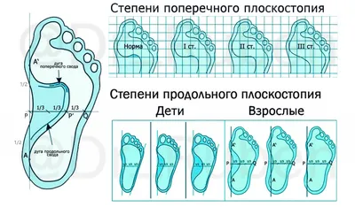 Лечение плоскостопия 2-3 степени у взрослых: продольного и поперечного