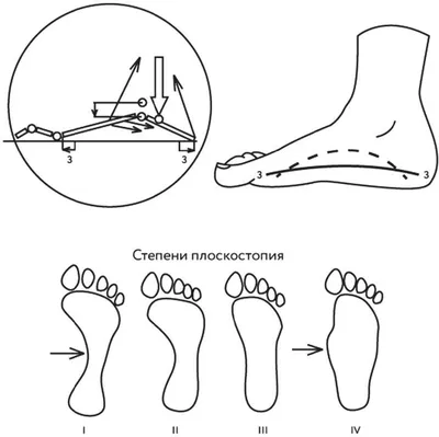 Плоскостопие: поперечное, продольное, ортопедические стельки