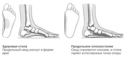 Плоскостопие, почему с ним не берут в армию - ООО Содействие