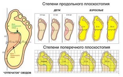 Плоскостопие: поперечное, продольное, ортопедические стельки