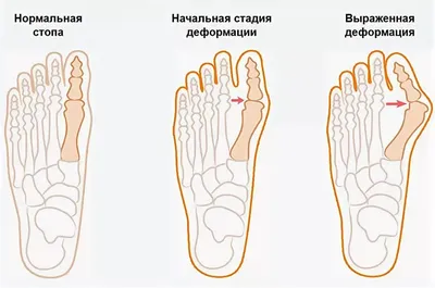 Продольное и поперечное плоскостопие