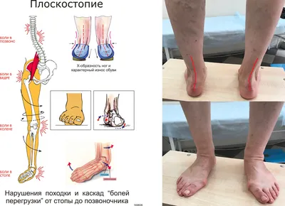 Школа ЗОЖ: как не допустить, чтобы из-за плоскостопия развился артроз |  Комиинформ