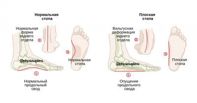 Чем опасно плоскостопие: последствия для организма, причины и риски  игнорирования