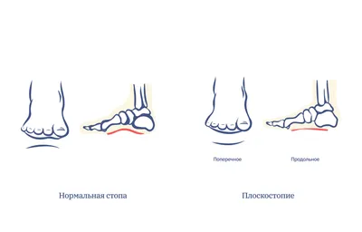 Плоскостопие 1 степени - лечение в Омске