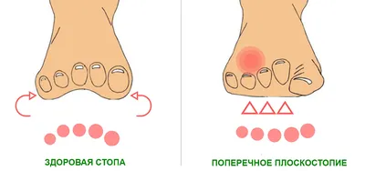 Лечение плоскостопия 2-3 степени у взрослых: продольного и поперечного