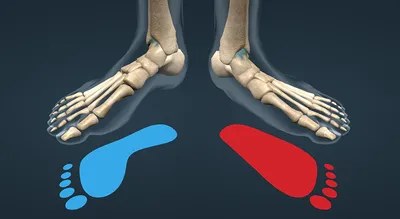 Плоскостопие, степени и разновидности, причины возникновения и лечение
