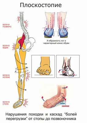 Лечение плоскостопия 2-3 степени у взрослых: продольного и поперечного