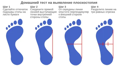 Лечение плоскостопия 2-3 степени у взрослых: продольного и поперечного