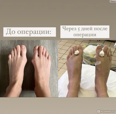 Hallux Valgus / Вальгусная деформация первого пальца стопы - «Самый  подробный отзыв про операцию и восстановление!В конце отзыва ссылка на  отзыв про удаление винтов и видео послеоперационной гимнастики!» | отзывы