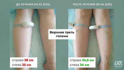 Отеки ног: причины и лечение, что делать - у женщин и мужчин| Медицинский  центр ФлебоПлюс