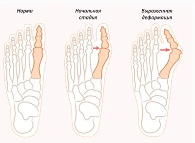 https://ortomed-clinic.ru/articles/hallux-valgus/shishka-na-vneshney-storone-stopy/