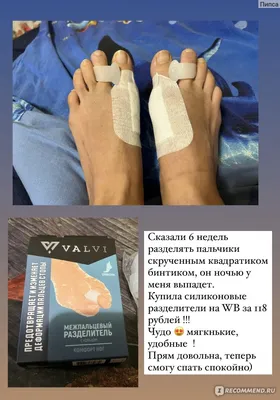 Hallux Valgus / Вальгусная деформация первого пальца стопы - «Это стоит  всех мучений !! » | отзывы