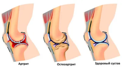 https://ortomed-clinic.ru/articles/hallux-valgus/shishka-na-vneshney-storone-stopy/