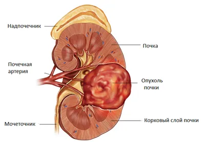 Камни в почка - лечение, удаление. Цена. | Клиника Сеченова